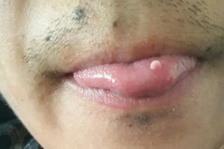 乳头状瘤样病变图