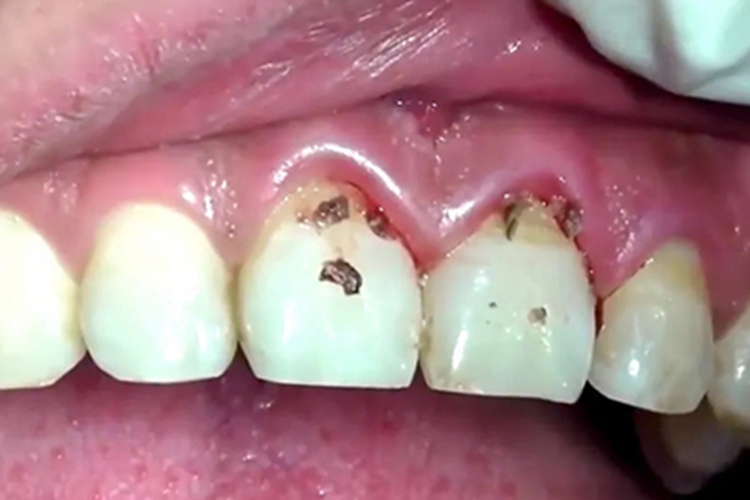 龈下结石症状图 龈下结石症状图