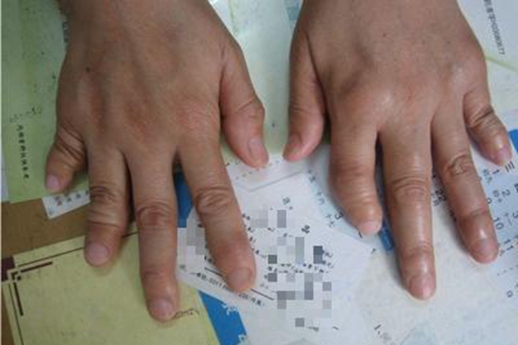 银屑病关节炎手部变形图