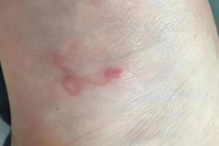 皮肤幼虫移行症脚部有线状红斑图