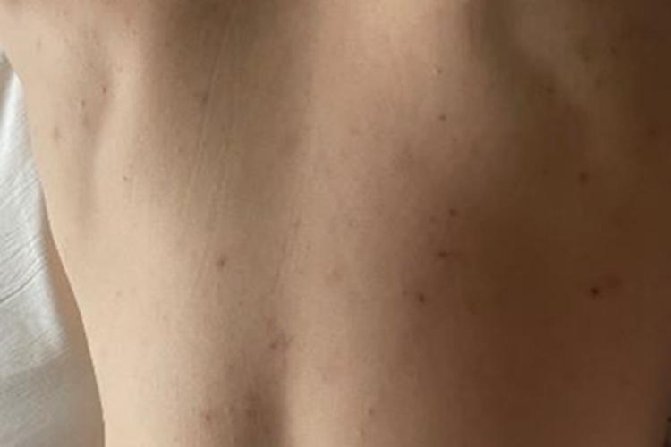 毛囊炎背部长红色小丘疹图