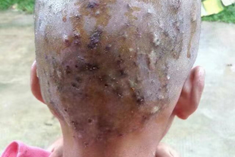 毛囊炎头皮结痂图 毛囊炎头皮结痂图