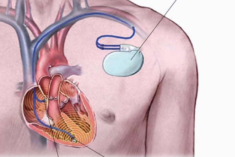 体内膈肌起搏器图