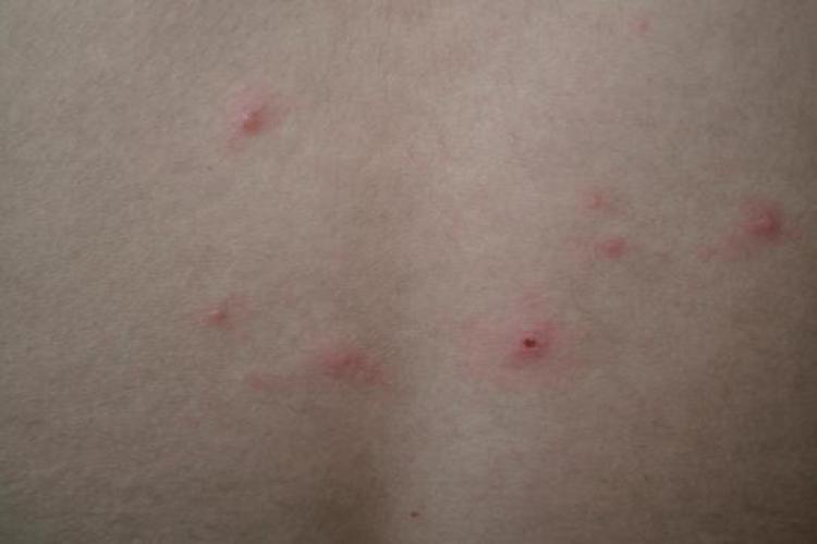 青少年水痘图 青少年水痘图