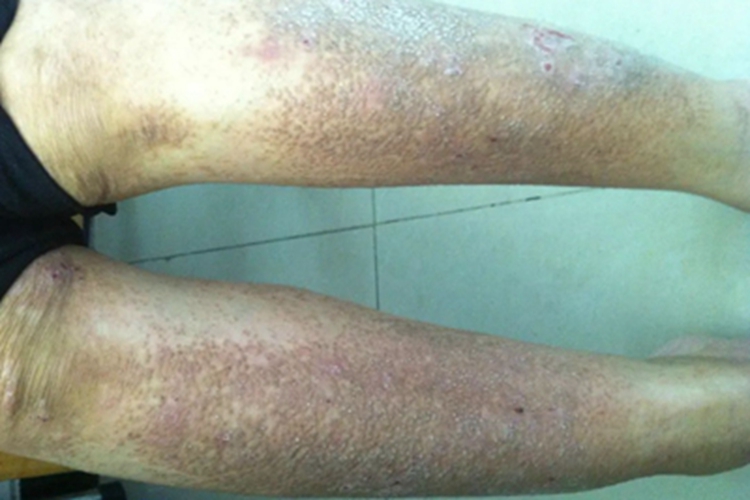 皮肤淀粉样变小腿红斑图