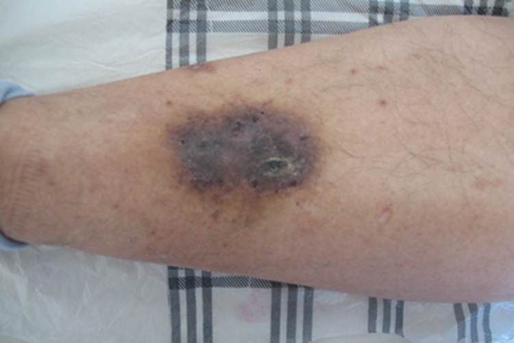 淤积性皮下硬化症小腿结痂图 淤积性皮下硬化症小腿结痂图