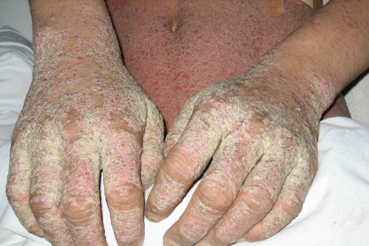 疥虫感染严重症状图 疥虫感染严重症状图