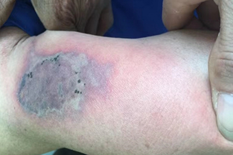 虫咬皮炎皮肤发紫图