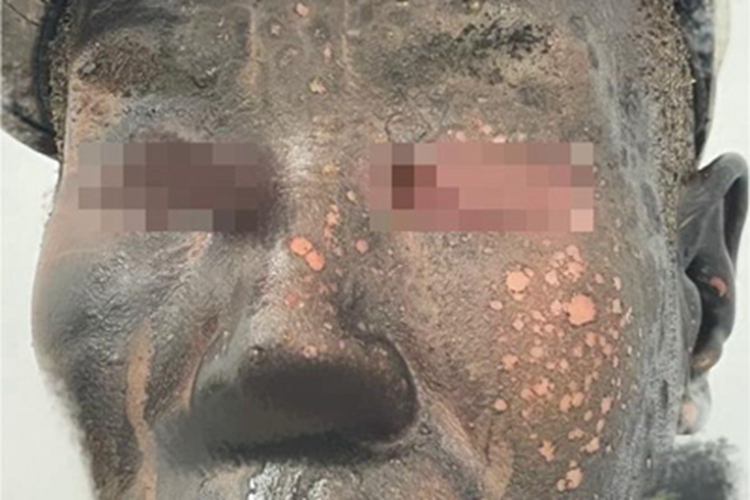 电烧伤面部发黑糊了图