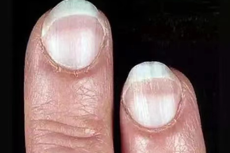 指甲发白图