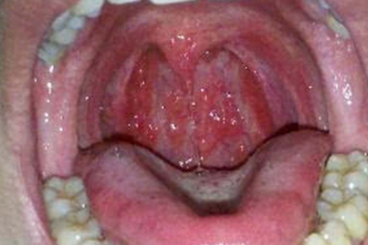 咽后壁疱疹图