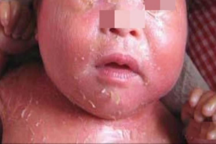 胶样婴儿面部结痂图