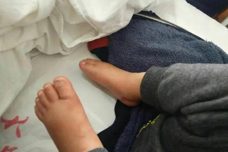 异型麻疹脚部水肿图 异型麻疹脚部水肿图