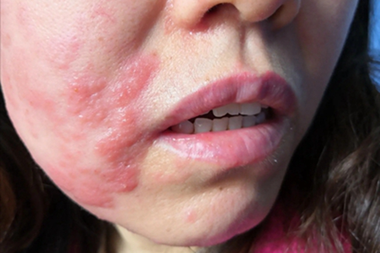 疱疹样脓疱病面部红斑图 疱疹样脓疱病面部红斑图