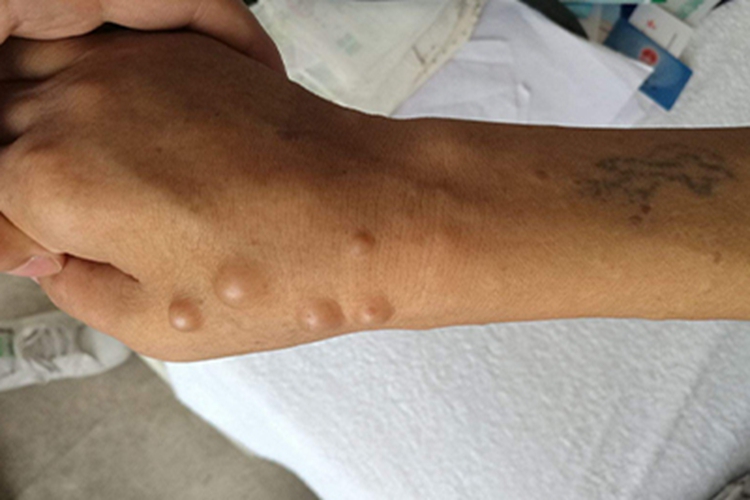 结节状神经纤维瘤图 结节状神经纤维瘤图