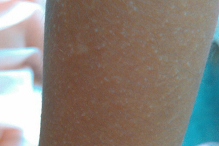 黏液水肿性苔藓胳膊长丘疹图