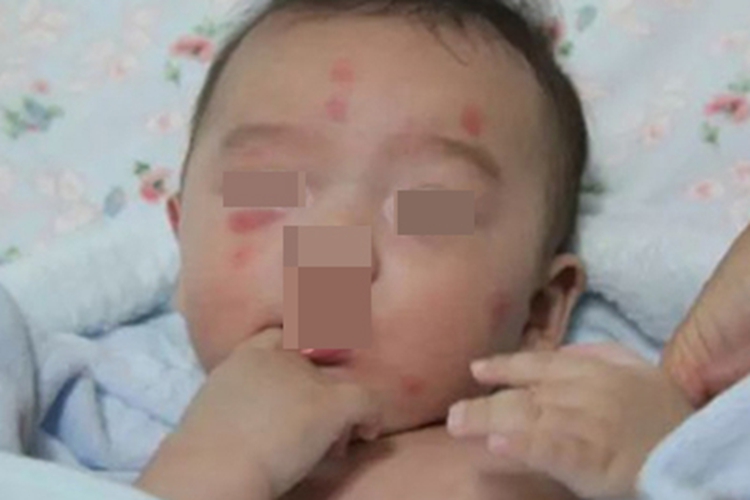 蚊虫叮咬红斑图 蚊虫叮咬红斑图