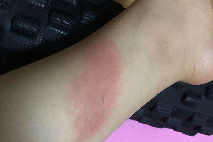 小腿烫伤Ⅰ度红斑图