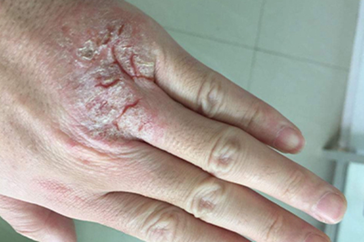 Ⅲ度皮肤皲裂皮肤增厚图 Ⅲ度皮肤皲裂皮肤增厚图