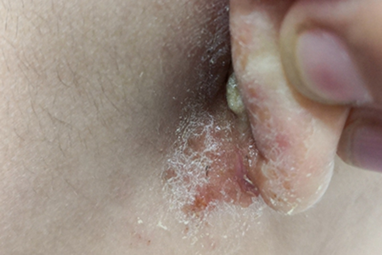 湿疹耳后结痂图 湿疹耳后结痂图