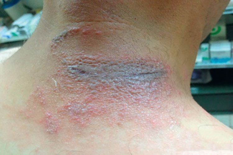 隐翅虫皮炎后颈部红斑水疱图