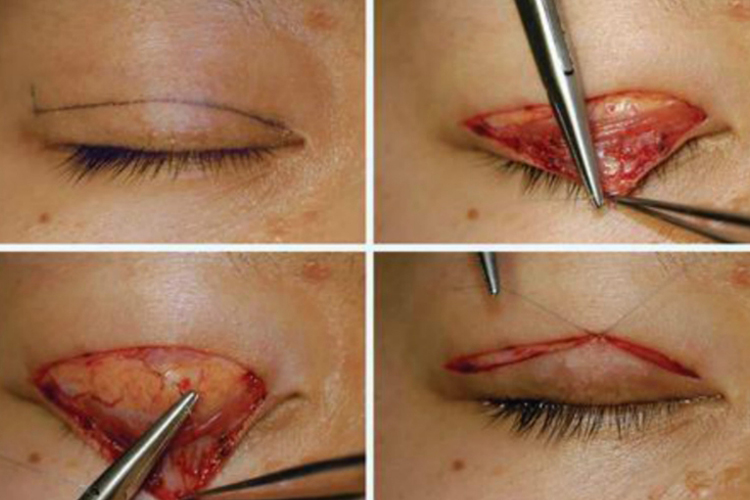 双眼皮手术皮肤切开法图 双眼皮手术皮肤切开法图