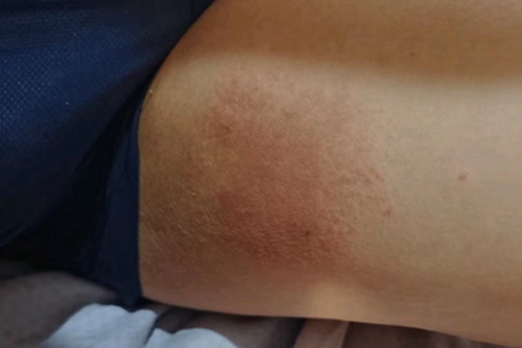 股癣大腿大面积发红增厚图