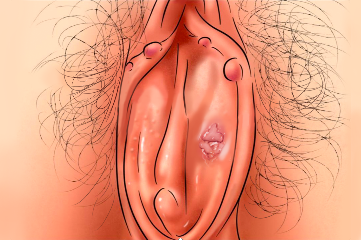 性病型急性女阴溃疡手绘图