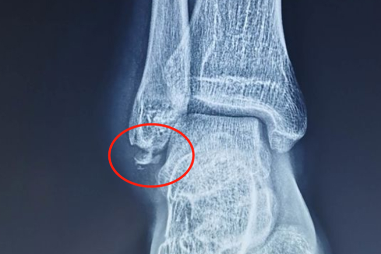 腓骨远端撕脱性骨折影像图 腓骨远端撕脱性骨折影像图