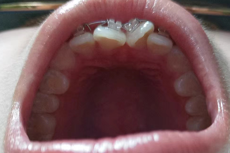 门牙往里凹图 门牙往里凹图