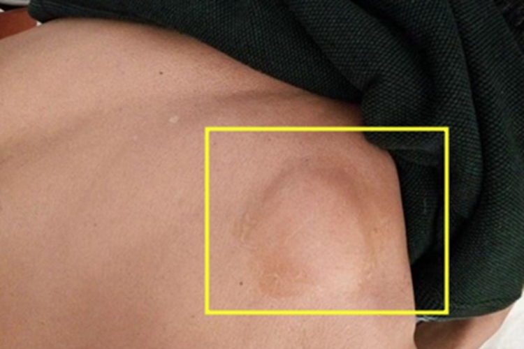 血管脂肪瘤腰部症状图 血管脂肪瘤腰部症状图