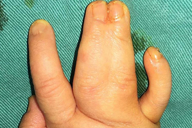 狭颅症两根手指粘连图