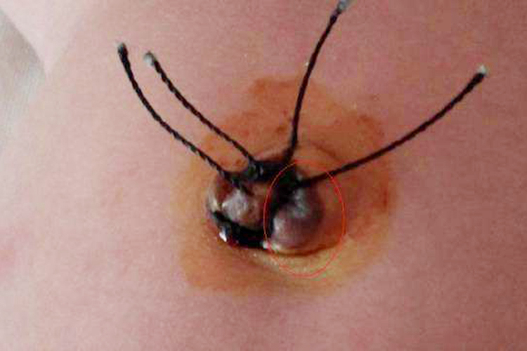 新生儿脐肉芽肿图