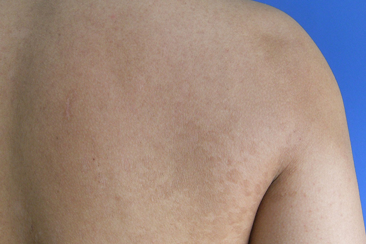 斑疹上覆有糠状鳞屑图