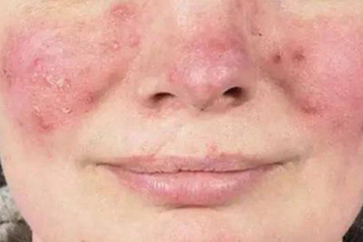 丘疹脓疱型酒糟鼻面部有疙瘩图