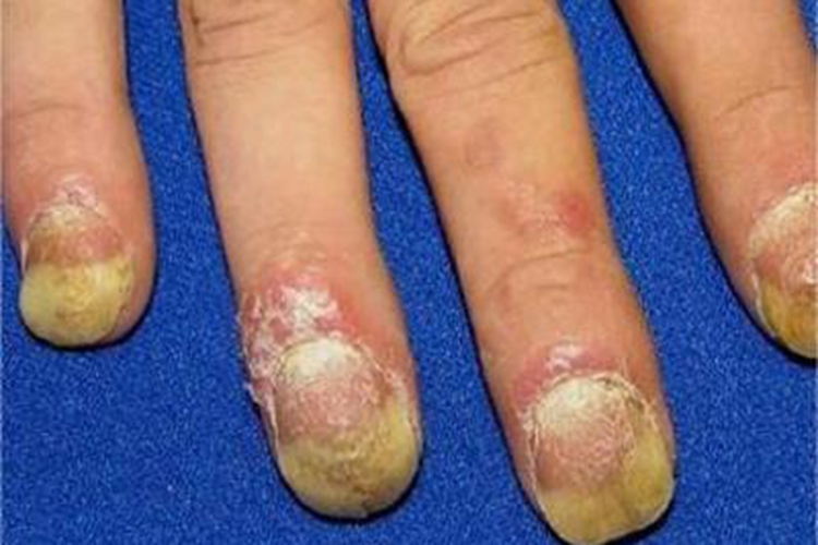 银屑病关节炎增厚图