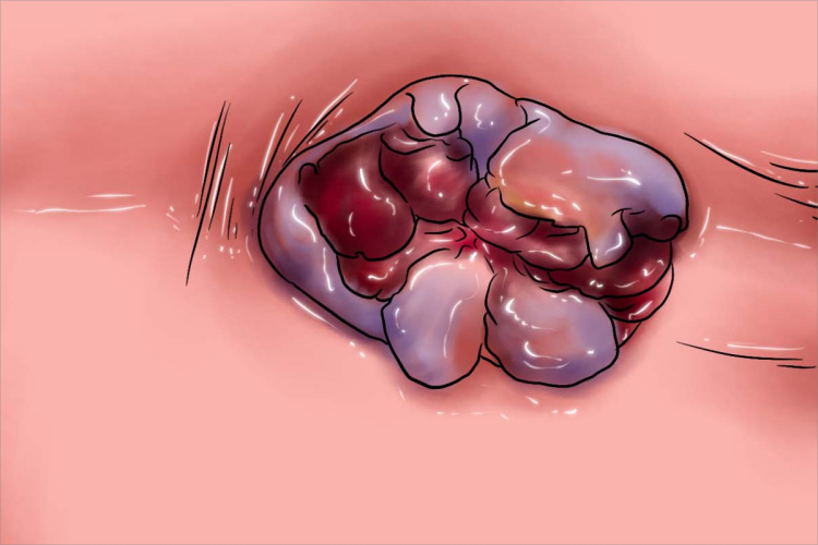 混合痔肛门疙瘩图