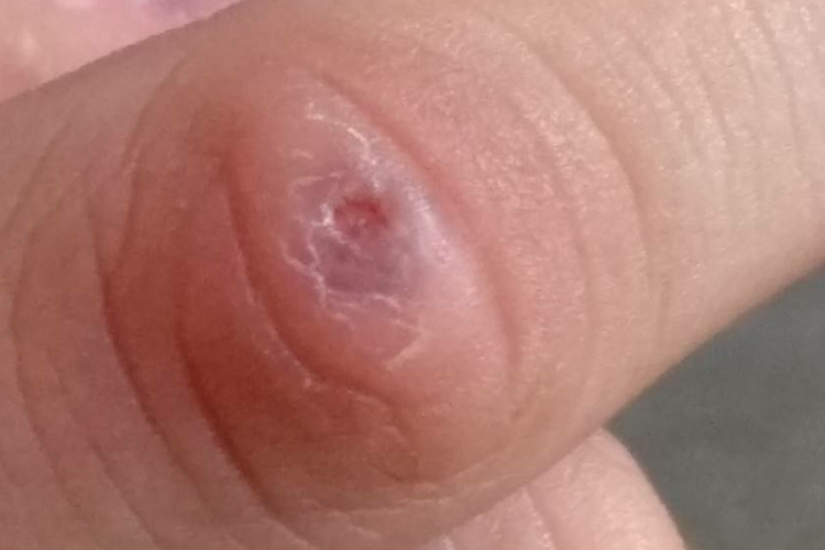 手指关节结核处有窦道图