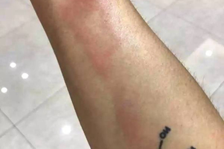 丝虫病急性期红斑图