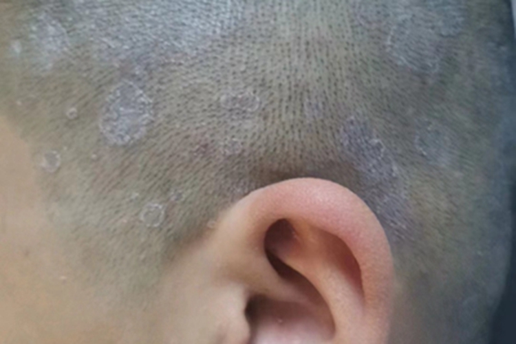 成人脂溢性皮炎头皮圆形状白斑图