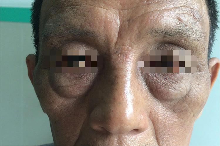 血色病面容图