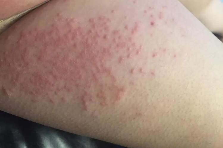 大腿内侧湿疹初期丘疱疹图