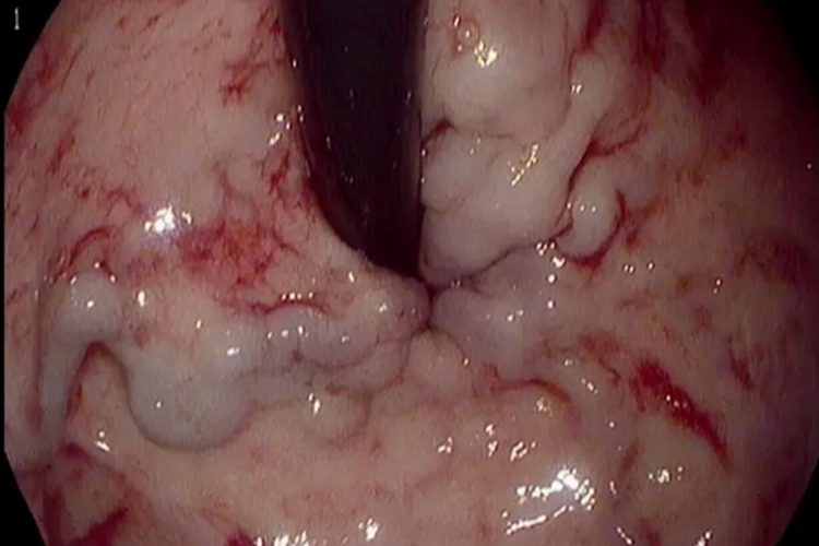 胃底-食管静脉曲张图