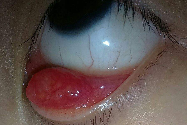 撅眼严重的图片