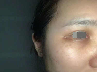 眶周色素沉着症眼周皮肤颜色加深图.jpg