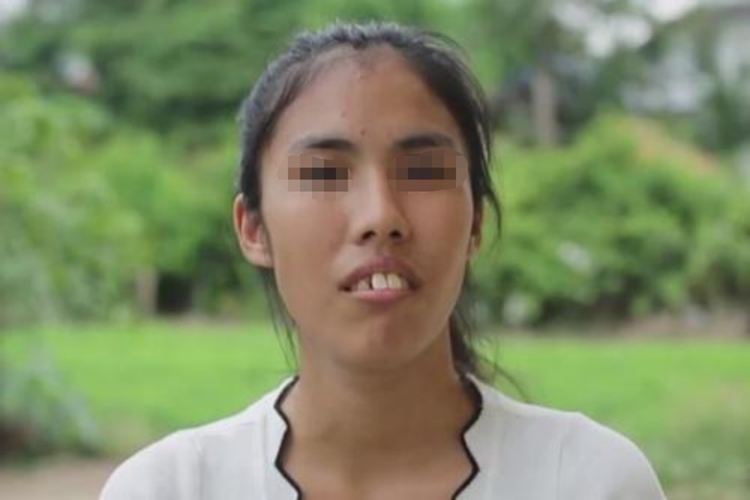 龅牙齿双唇闭合困难图 龅牙齿双唇闭合困难图