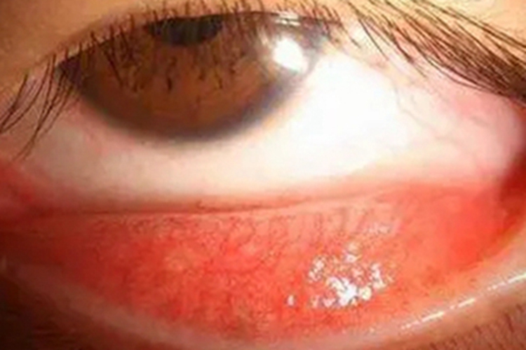 流行性角结膜炎结膜小疙瘩图