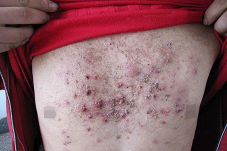 聚合性痤疮胸部黑头粉刺图