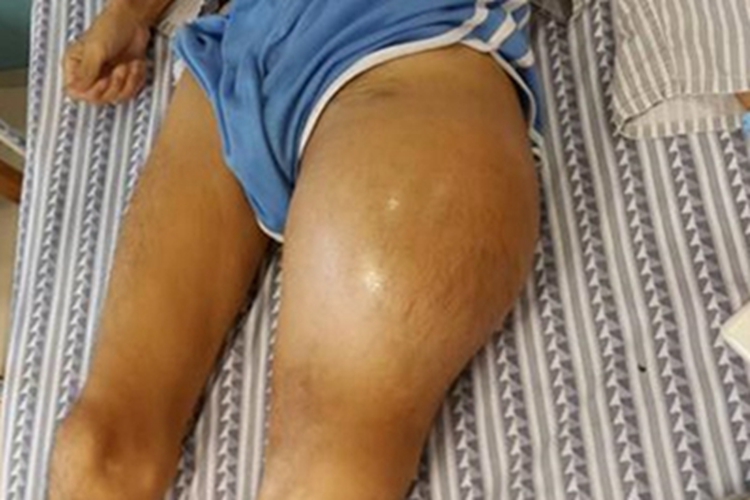 恶性纤维组织细胞瘤大腿长肿块图 恶性纤维组织细胞瘤大腿长肿块图