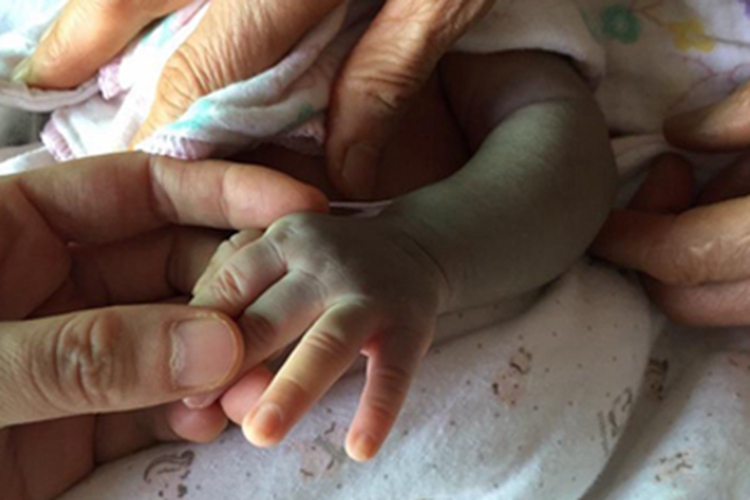 色素型胎记胳膊斑图